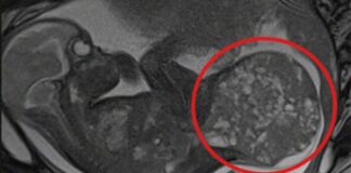 Bebê nasce com tumor que ocupa metade do corpo e é salvo por cirurgia Bebe nasce d24am 1024x580