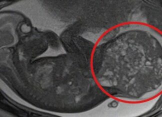 Bebê nasce com tumor que ocupa metade do corpo e é salvo por cirurgia Bebe nasce d24am 1024x580