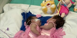 Gêmeas siamesas do AM recebem alta da UTI após cirurgia complexa de separação