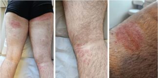 ‘Superfungo’ genital se espalha no Reino Unido e acende alerta entre autoridades