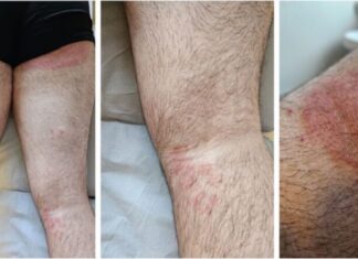 ‘Superfungo’ genital se espalha no Reino Unido e acende alerta entre autoridades