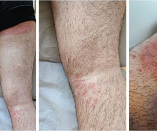 ‘Superfungo’ genital se espalha no Reino Unido e acende alerta entre autoridades