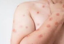 Secretaria de Saúde confirma segundo caso de mpox do grupo lp em SP