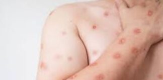 Secretaria de Saúde confirma segundo caso de mpox do grupo lp em SP