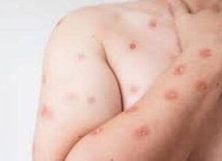 Secretaria de Saúde confirma segundo caso de mpox do grupo lp em SP