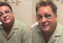 Leonardo surge com olho roxo após queda e vai parar no hospital